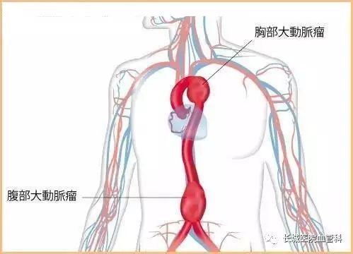 动脉大出血能活多久_动脉大出血怎么抢救_大动脉在哪